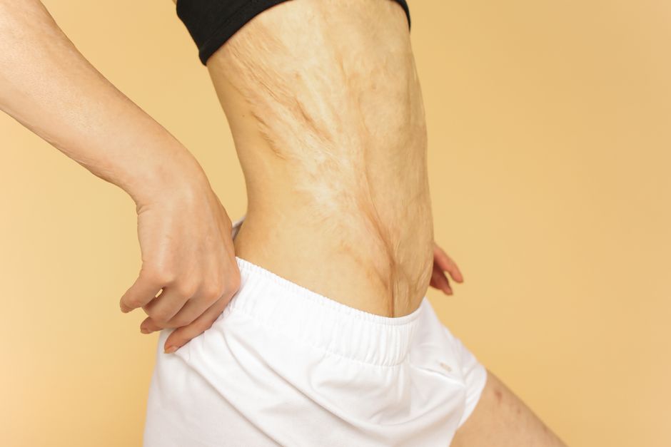 Stretch Mark Prevention for Women Over 40: A Complete System for Resilient Skin