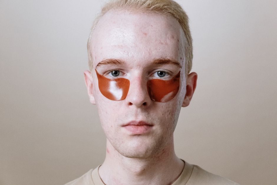 6 Common Acne Treatment Mistakes That Keep Your Skin from Clearing Up