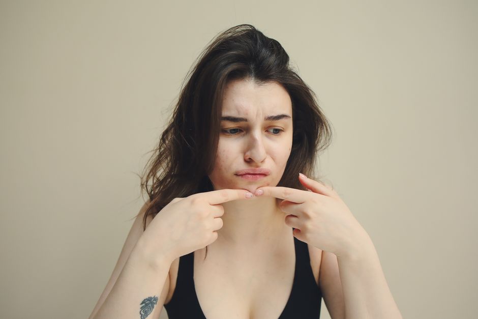 Summer Acne Survival Guide: How to Keep Your Skin Clear When the Heat Turns Up