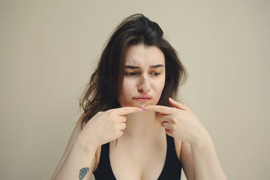 Summer Acne Survival Guide: How to Keep Your Skin Clear When the Heat Turns Up