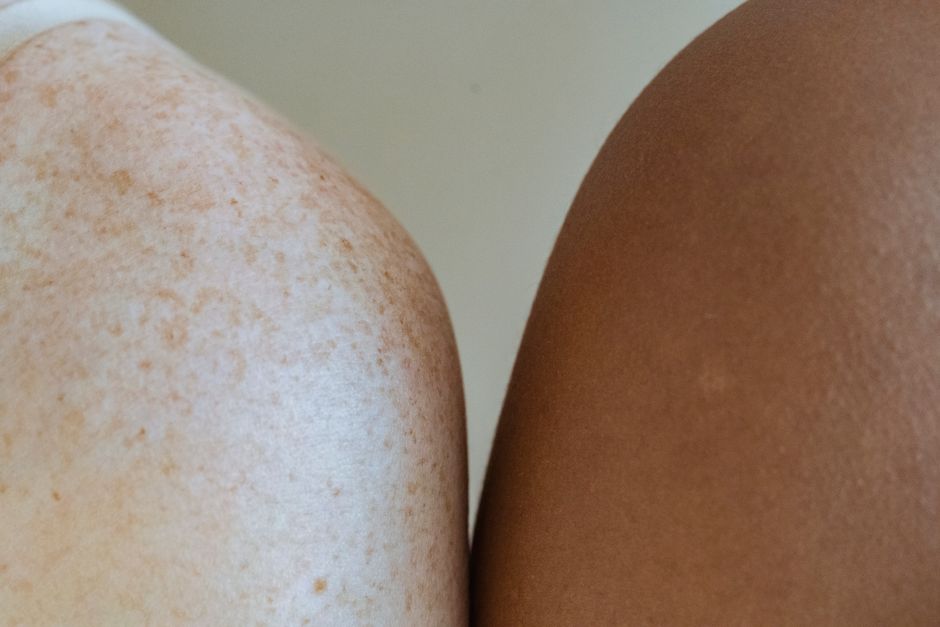 Cellulite Reduction for Combination Skin: A Practical Guide to Balancing Texture and Tone