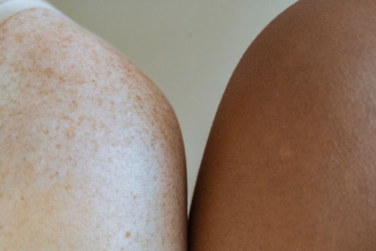 Cellulite Reduction for Combination Skin: A Practical Guide to Balancing Texture and Tone