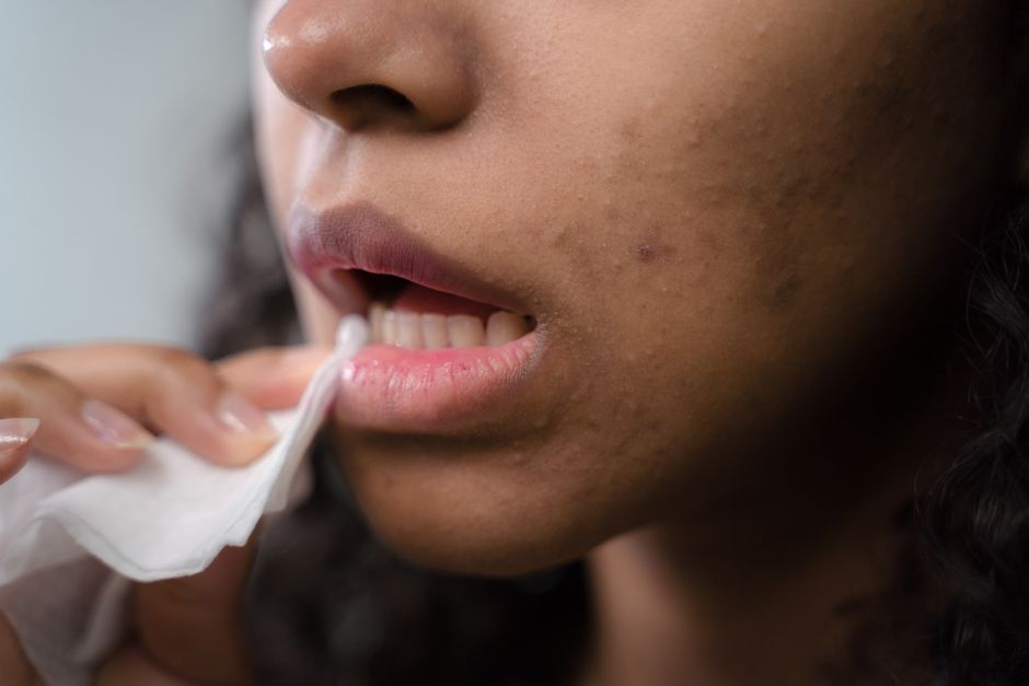 The Allergy-Friendly Guide to Acne Treatment: Best Products for Sensitive Skin